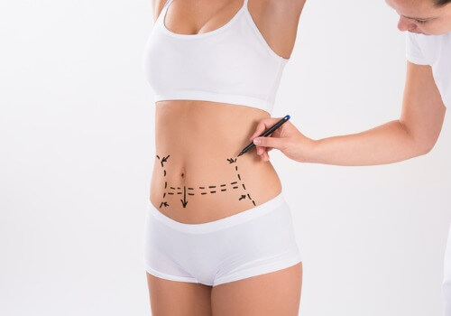 surgeon-preparing-woman-for-liposuction-surgery-picture-id609695754